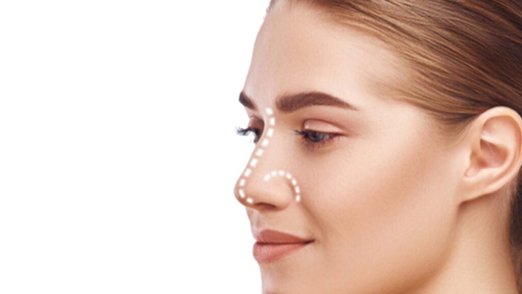 Rhinoplastie Nez Prix Medespoir