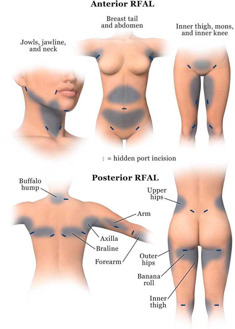 Female Breast Anatomy - Medespoir