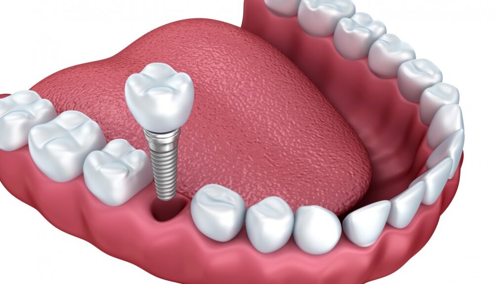 implant dents manquantes