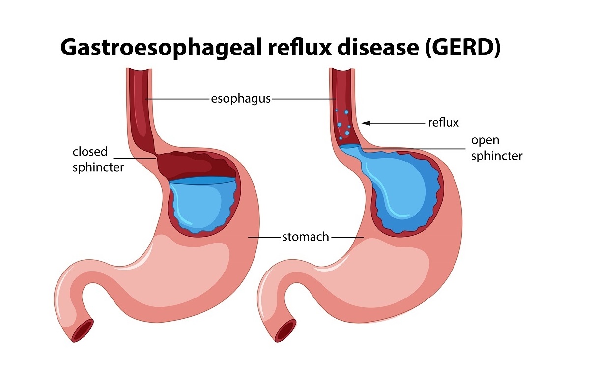 Nissen Sleeve : opération obésité et reflux Gastro-Œsophagien