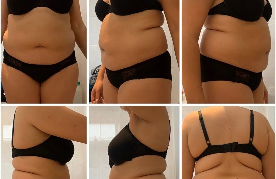 liposuccion 360 degré pour Suisses