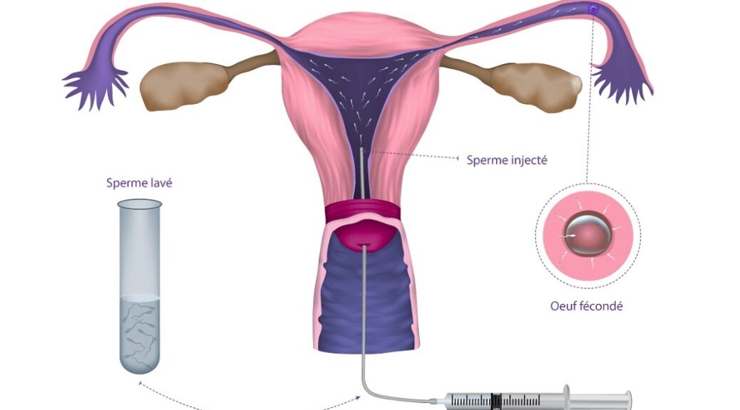 Insémination intra-utérine