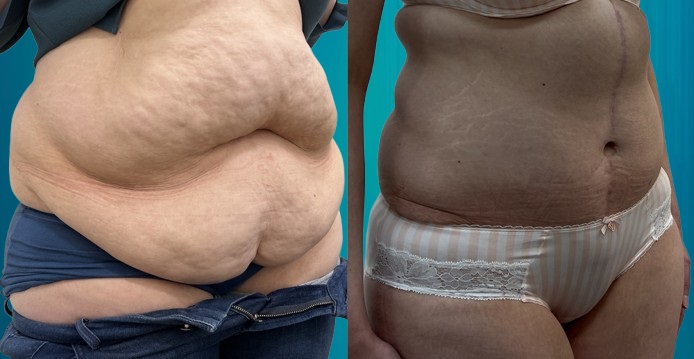 abdominoplastie pour Suisses