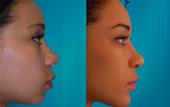 Rhinoplastie ethnique Suisses