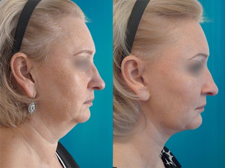 lipofilling visage pour Suisses