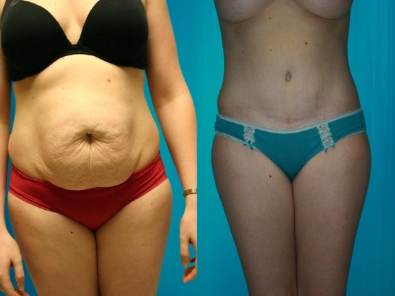 abdominoplastie avec liposuccion