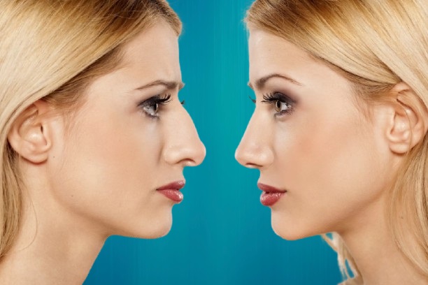 blepharoplastie et rhinoplastie combinées