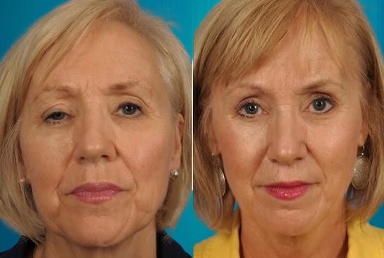 blépharoplastie inférieure