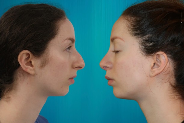 rhinoplastie pour Suisses