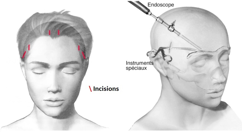 lifting endoscopique tunisie